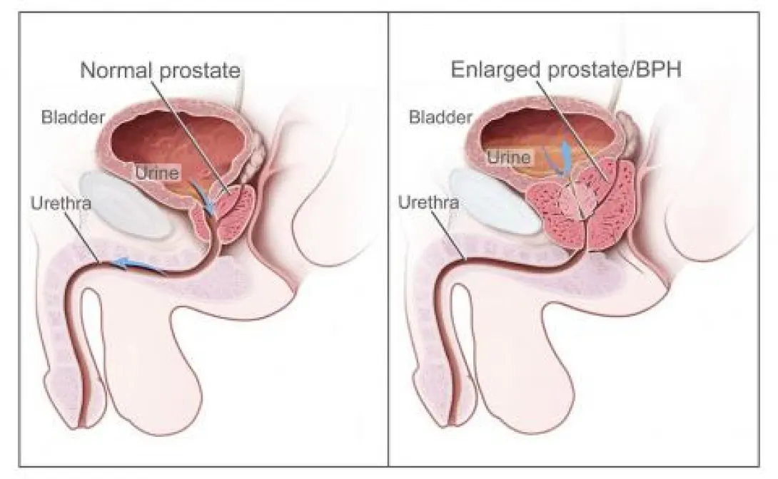 dr-fabrisio-barbosa-blog-HOLEP-Tecnica-Avancada-para-o-Tratamento-da-Hiperplasia-Prostatica-Benigna-2