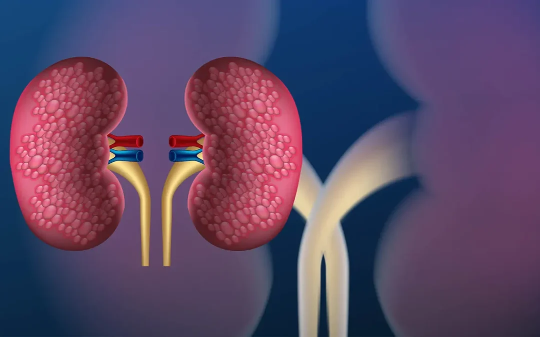 Litíase Renal (Pedra nos Rins): Causas, Sintomas, Diagnóstico e Tratamentos Atuais
