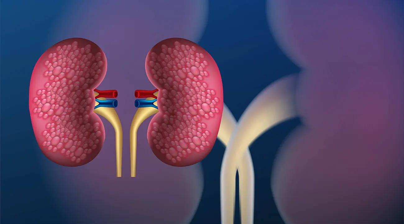dr-fabrisio-barbosa-blog-Litiase-Renal_Pedra-nos-Rins_Causas-Sintomas-Diagnostico-e-Tratamentos-Atuais